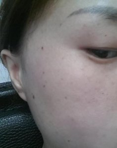 ​脸上为什么会长痣出来(脸上长了黑痣是什么原因)