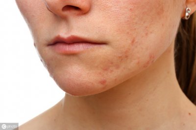 ​痤疮严重 痤疮按照严重程度分4级，不同症状用药建议，收藏