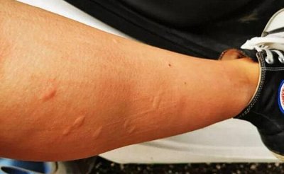 O型血更招蚊子是真的还是假的?