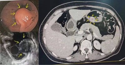​胃镜下肿瘤切除术 胃镜下肿瘤的特征