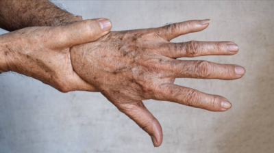 ​老年斑怎么办最有效的方法（人老了，为什么有老年斑？如何淡化去除？3种方法