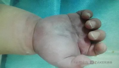 压脉带怎样压迫动脉(一根压脉带差点毁了一只手)