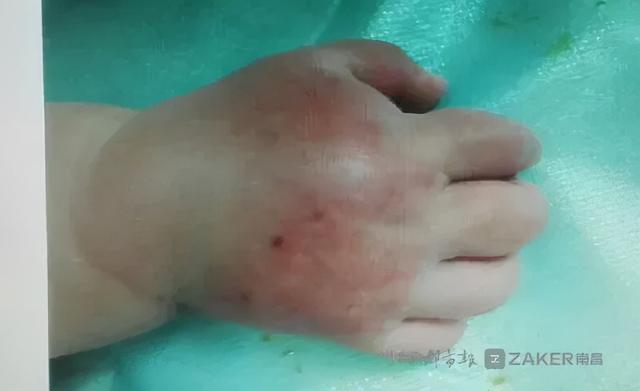 压脉带怎样压迫动脉（一根压脉带差点毁了一只手）(2)