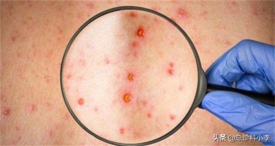​身上有红色的小血点不痒不疼痛 身上出现很多小红点，不痛不痒是怎么回事？听听
