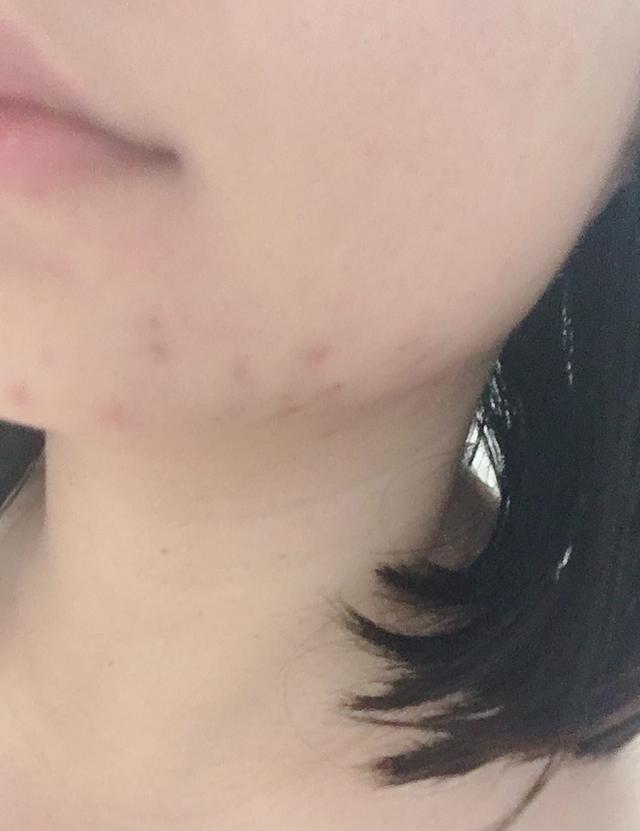 理肤泉清痘净肤精华乳效果怎么样(祛痘细致精华乳怎么样)(5)